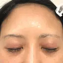 二重切開 BIANCA銀座 DAY 89 サムネイル用