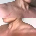 ボトックス（肩） 湘南美容クリニック 奈良院 DAY 9 サムネイル用