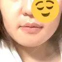 バッカルファット除去 / セットバック 銀座フェイスクリニック（小顔整形・輪郭整形專門） DAY 24 サムネイル用