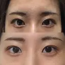 目尻切開 / タレ目形成・グラマラスライン（切開） A CLINIC（エークリニック） 銀座院 DAY 42 サムネイル用