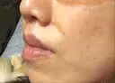 人中短縮 銀座アテナクリニック DAY 62 サムネイル用