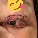 二重切開 / 目頭切開 / 眼瞼下垂（切開） / 鼻中隔延長（切開） / 小鼻縮小（切開） / タレ目形成・グラマラスライン（切開） / 軟骨移植 / 目尻靭帯移動 / 鼻尖縮小 / 口角挙上 / 鼻翼基部形成（貴族手術） 大阪TAクリニック DAY 1 サムネイル用