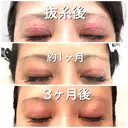 二重切開 BIANCA銀座 DAY 93 サムネイル用