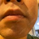医療脱毛（顔） 自由が丘クリニック DAY 3 サムネイル用