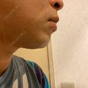 医療脱毛（顔） 自由が丘クリニック DAY 14 サムネイル用
