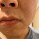 医療脱毛（顔） 自由が丘クリニック AFTER サムネイル用