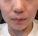 ボトックス（エラ・小顔） パールスキンクリニック天神 DAY 12 サムネイル用