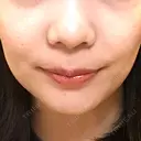 ボトックス（エラ・小顔） パールスキンクリニック天神 DAY 96 サムネイル用