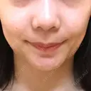 ボトックス（エラ・小顔） パールスキンクリニック天神 DAY 117 サムネイル用
