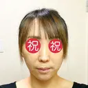 切開リフト 石倉クリニック 水戸院 DAY 31 サムネイル用