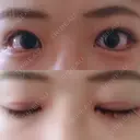 二重切開 / 眼瞼下垂（切開） / 目尻切開 ジュエリー美容外科 DAY 24 サムネイル用
