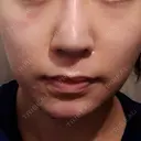 隆鼻術 / 鼻尖形成（切開） / 軟骨移植 / 鼻修正 湘南美容クリニック 柏院 DAY 309 サムネイル用