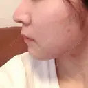隆鼻術 / 鼻尖形成（切開） / 軟骨移植 / 鼻修正 湘南美容クリニック 柏院 DAY 317 サムネイル用