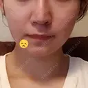 隆鼻術 / 鼻尖形成（切開） / 軟骨移植 / 鼻修正 湘南美容クリニック 柏院 DAY 317 サムネイル用