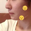 隆鼻術 / 鼻尖形成（切開） / 軟骨移植 / 鼻修正 湘南美容クリニック 柏院 DAY 317 サムネイル用