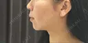 バッカルファット除去 / 脂肪吸引（顔） 湘南美容クリニック 那覇院 DAY 152 サムネイル用