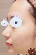 隆鼻術 / 鼻尖形成（切開） / 鼻中隔延長（切開） / 軟骨移植 グロービー美容整形外科 DAY 8 サムネイル用
