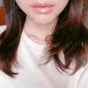 口唇縮小術 くさのたろうクリニック DAY 42 サムネイル用