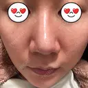 鼻尖形成（切開） / ヒアルロン酸注入（鼻） 東京ヒルズクリニック 新宿院 DAY 76 サムネイル用