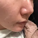 鼻尖形成（切開） / ヒアルロン酸注入（鼻） 東京ヒルズクリニック 新宿院 DAY 76 サムネイル用