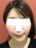 糸リフト / バッカルファット除去 / 脂肪吸引（顔） / ボトックス（エラ・小顔） 湘南美容クリニック 秋葉原院 AFTER サムネイル用