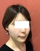 糸リフト / バッカルファット除去 / 脂肪吸引（顔） / ボトックス（エラ・小顔） 湘南美容クリニック 秋葉原院 DAY 105 サムネイル用