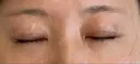 眼瞼下垂（切開） くさのたろうクリニック DAY 11 サムネイル用