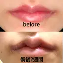 二重切開 / 目頭切開 / 眼瞼下垂（切開） / 鼻中隔延長（切開） / 小鼻縮小（切開） / タレ目形成・グラマラスライン（切開） / 軟骨移植 / 目尻靭帯移動 / 鼻尖縮小 / 口角挙上 / 鼻翼基部形成（貴族手術） 大阪TAクリニック AFTER サムネイル用