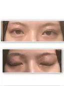 二重埋没 / 上まぶたの脂肪取り / 眉下切開 湘南美容クリニック 高田馬場院 DAY 31 サムネイル用