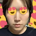 脂肪溶解注射（顔） 赤坂プレミアクリニック DAY 6 サムネイル用