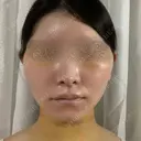 脂肪吸引（顔） / 輪郭修正 / 切開リフト / その他（輪郭） ドクターゴールドマンクリニック 東京高輪院 DAY 4 サムネイル用