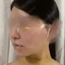 脂肪吸引（顔） / 輪郭修正 / 切開リフト / その他（輪郭） ドクターゴールドマンクリニック 東京高輪院 DAY 4 サムネイル用