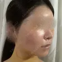 脂肪吸引（顔） / 輪郭修正 / 切開リフト / その他（輪郭） ドクターゴールドマンクリニック 東京高輪院 DAY 4 サムネイル用