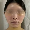 脂肪吸引（顔） / 輪郭修正 / 切開リフト / その他（輪郭） ドクターゴールドマンクリニック 東京高輪院 DAY 5 サムネイル用