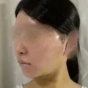 脂肪吸引（顔） / 輪郭修正 / 切開リフト / その他（輪郭） ドクターゴールドマンクリニック 東京高輪院 DAY 5 サムネイル用