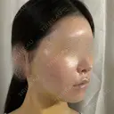 脂肪吸引（顔） / 輪郭修正 / 切開リフト / その他（輪郭） ドクターゴールドマンクリニック 東京高輪院 DAY 5 サムネイル用