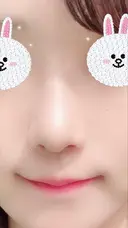 隆鼻術 / 鼻尖形成（切開） / 鼻中隔延長（切開） / 軟骨移植 グロービー美容整形外科 DAY 10 サムネイル用