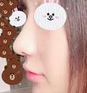 隆鼻術 / 鼻尖形成（切開） / 鼻中隔延長（切開） / 軟骨移植 グロービー美容整形外科 DAY 10 サムネイル用