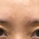 シワ取りボトックス 青山外苑前クリニック DAY 5 サムネイル用