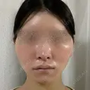 脂肪吸引（顔） / 輪郭修正 / 切開リフト / その他（輪郭） ドクターゴールドマンクリニック 東京高輪院 AFTER サムネイル用