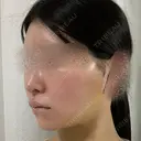 脂肪吸引（顔） / 輪郭修正 / 切開リフト / その他（輪郭） ドクターゴールドマンクリニック 東京高輪院 DAY 9 サムネイル用