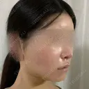 脂肪吸引（顔） / 輪郭修正 / 切開リフト / その他（輪郭） ドクターゴールドマンクリニック 東京高輪院 DAY 9 サムネイル用