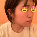脂肪溶解注射（顔） 赤坂プレミアクリニック DAY 11 サムネイル用