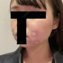 脂肪溶解注射（顔） 赤坂プレミアクリニック DAY 0 サムネイル用