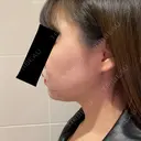 脂肪溶解注射（顔） 赤坂プレミアクリニック DAY 0 サムネイル用