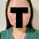 脂肪溶解注射（顔） 赤坂プレミアクリニック DAY 4 サムネイル用