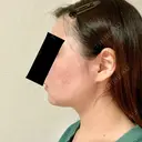 脂肪溶解注射（顔） 赤坂プレミアクリニック DAY 4 サムネイル用