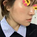 脂肪溶解注射（顔） 赤坂プレミアクリニック DAY 12 サムネイル用