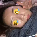 脂肪溶解注射（顔） / PRP皮膚再生療法 閉院｜プルージュ美容クリニック 赤羽院 DAY 5 サムネイル用