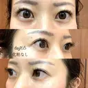 眉下切開 湘南美容クリニック 秋葉原院 AFTER サムネイル用